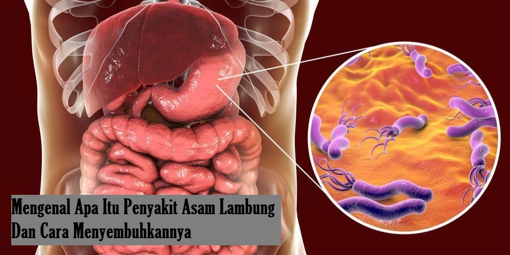 Mengenal Apa Itu Penyakit Asam Lambung Dan Cara Menyembuhkannya