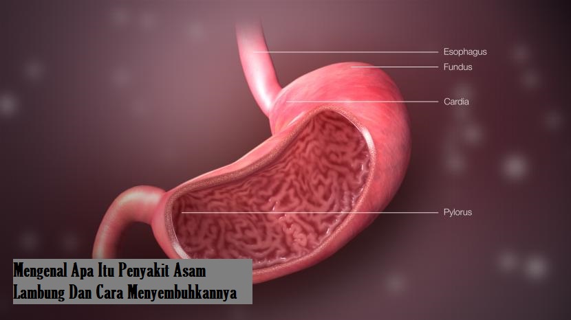 Mengenal Apa Itu Penyakit Asam Lambung Dan Cara Menyembuhkannya